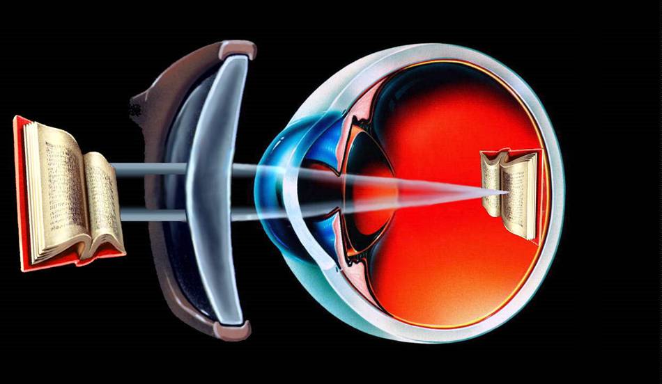 hyperopic correction